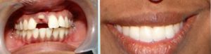 Dental bridges before and after images
